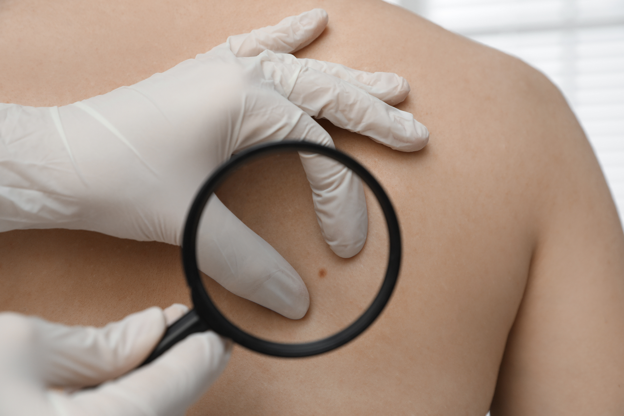 Dermatolog Koper mi je odpravil težave s kožo